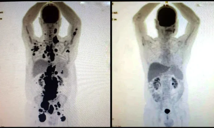 cancer-antes_depois