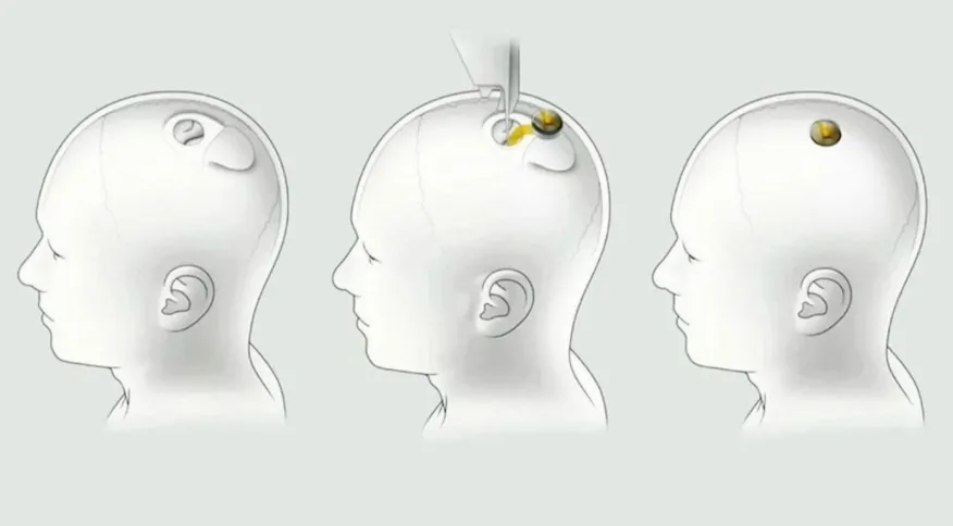 Empresa de Musk está autorizada a testar chips cerebrais em humanos nos EUA